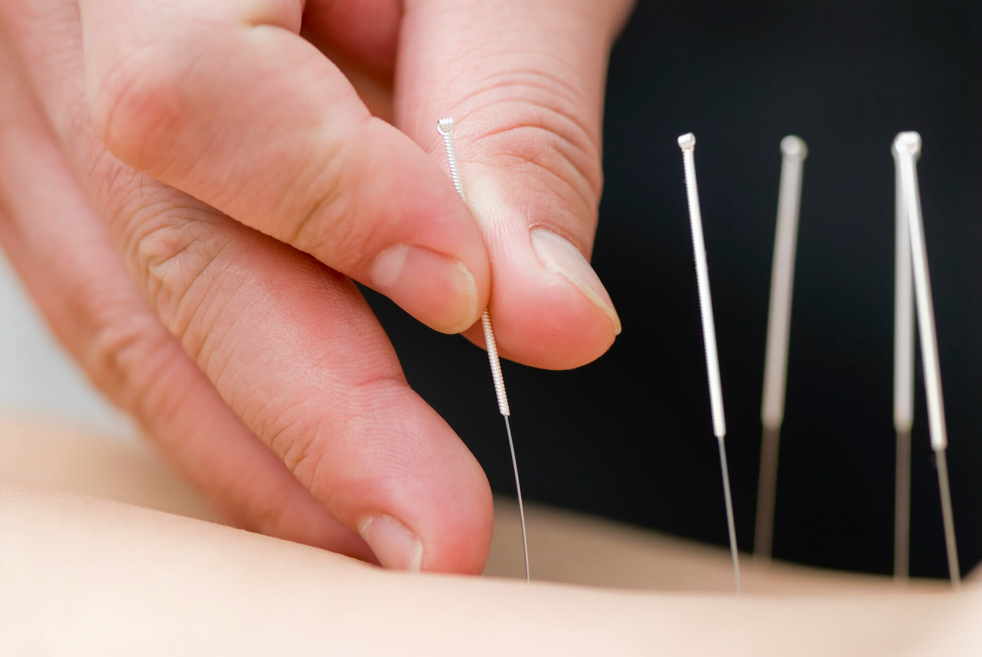 Acupuncture Orleans